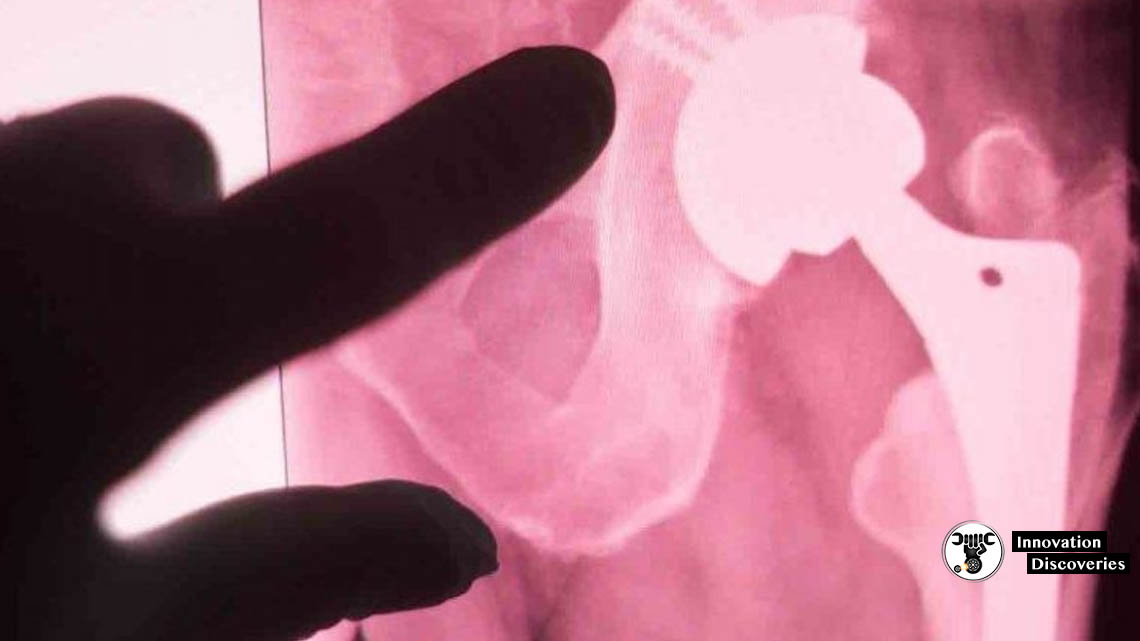 New Implants Heal Broken Bones By Becoming Bones Themselves | Innovation Discoveries
